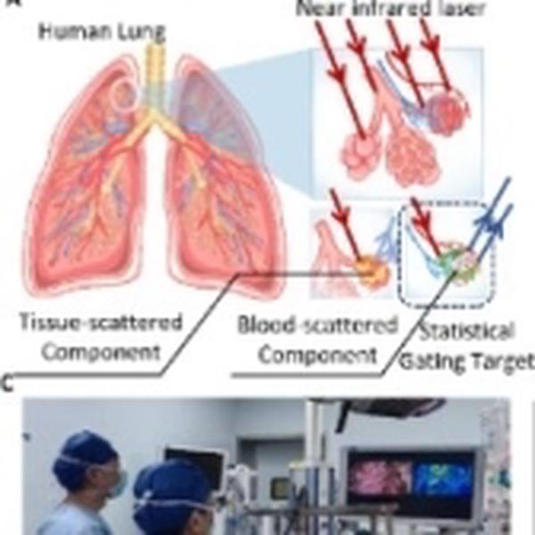 Image-guided thoracoscopic segmentectomy via single-shot statistical gating of blood-scattered laser speckle